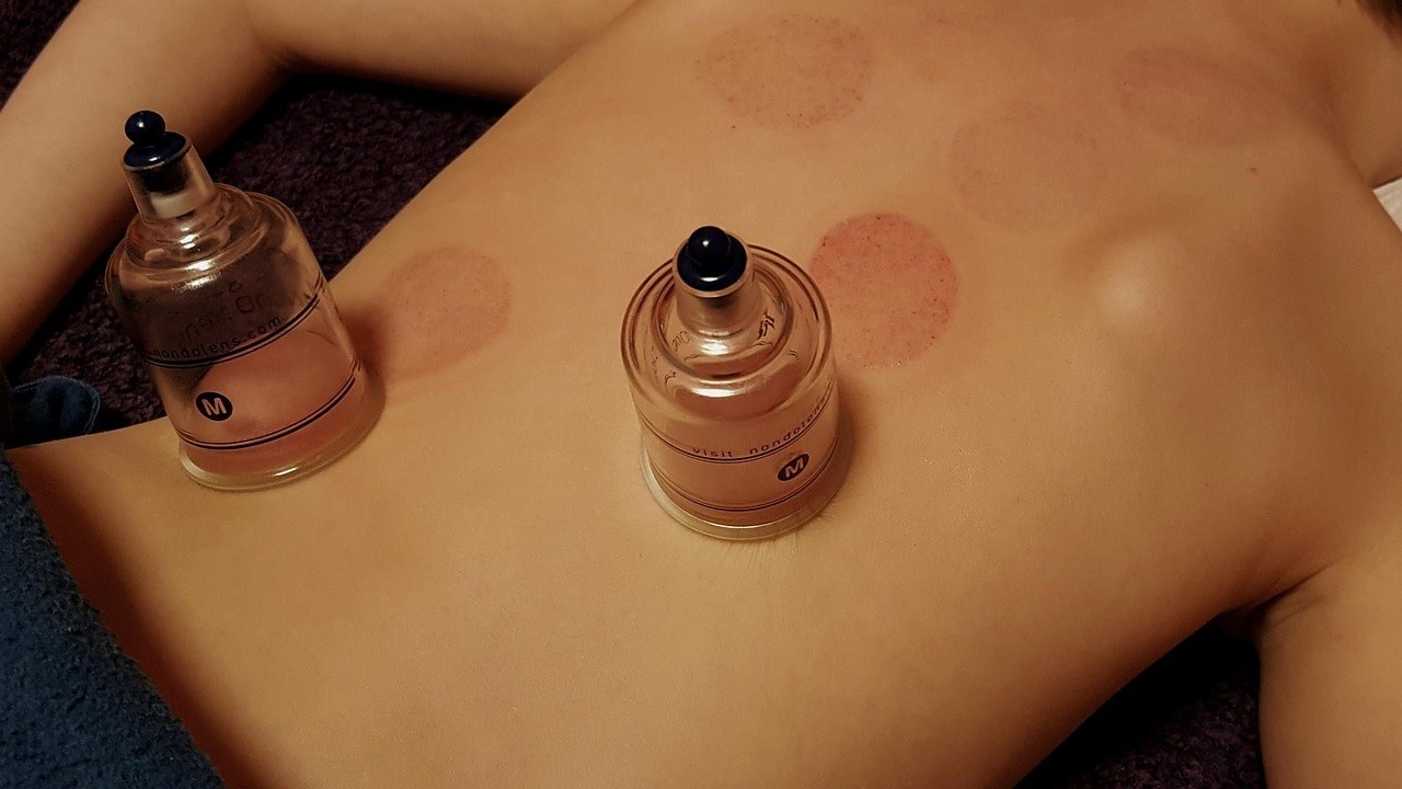 Cupping is one of the healing methods used by holistic healers.