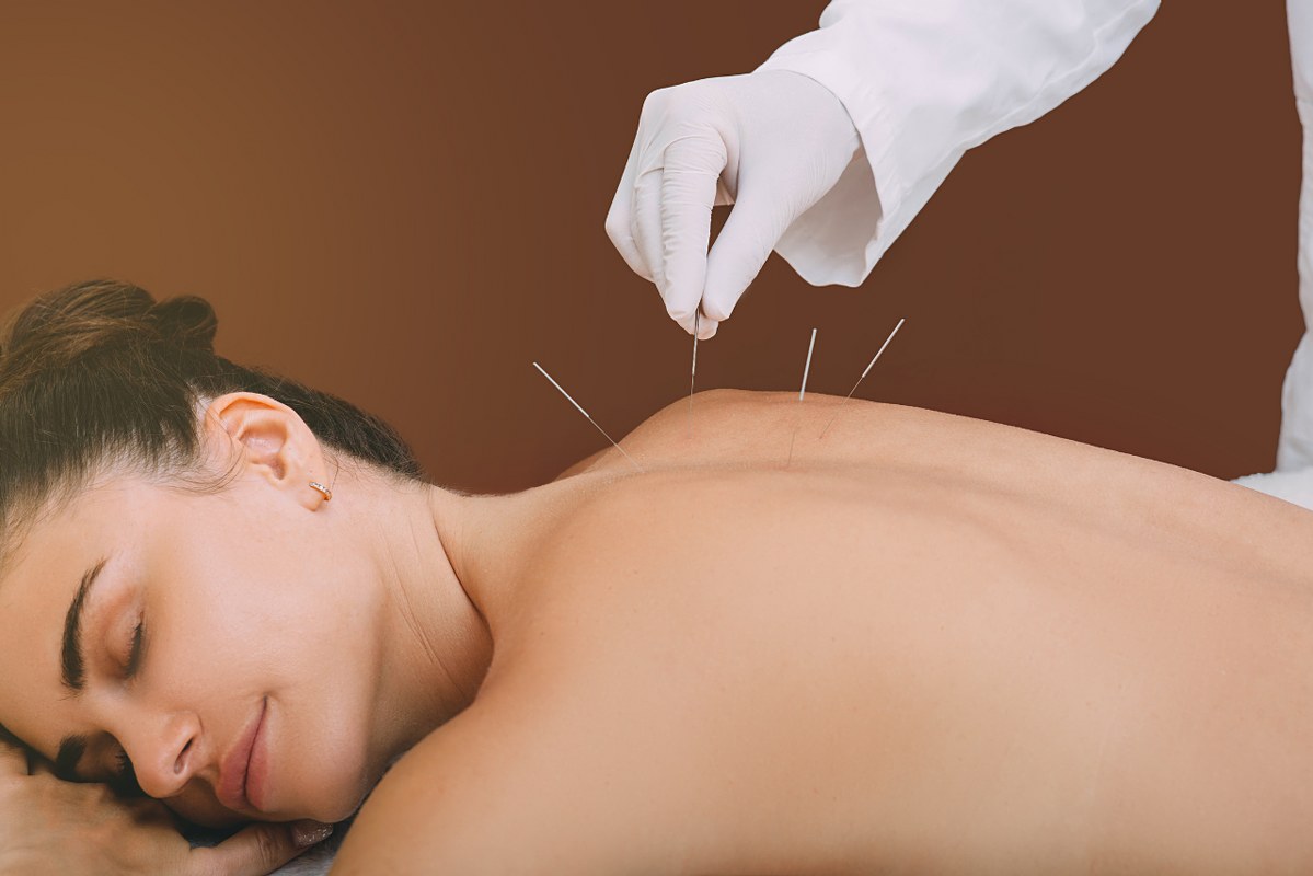 Therapist putting on acupuncture needles to woman's back.